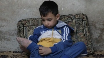 Esed rejiminin sakat bıraktığı 6 yaşındaki çocuk protez desteği bekliyor